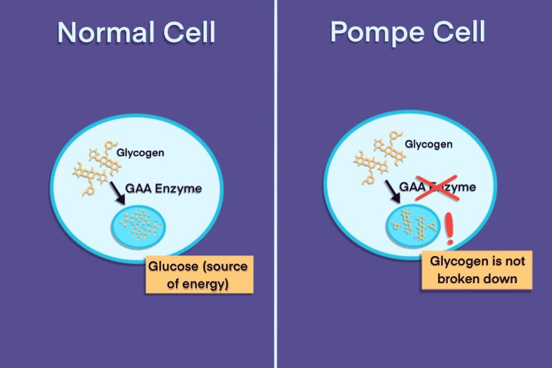 Pompe overview | Pompe News Today | infographic depicting the differences between normal cells and Pompe cells