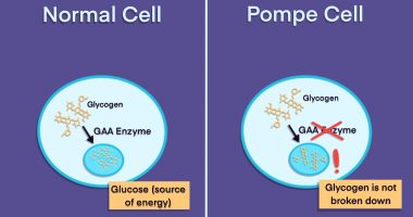 Pompe overview | Pompe News Today | infographic depicting the differences between normal cells and Pompe cells