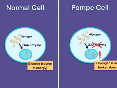 infographic depicting the differences between normal cells and Pompe cells