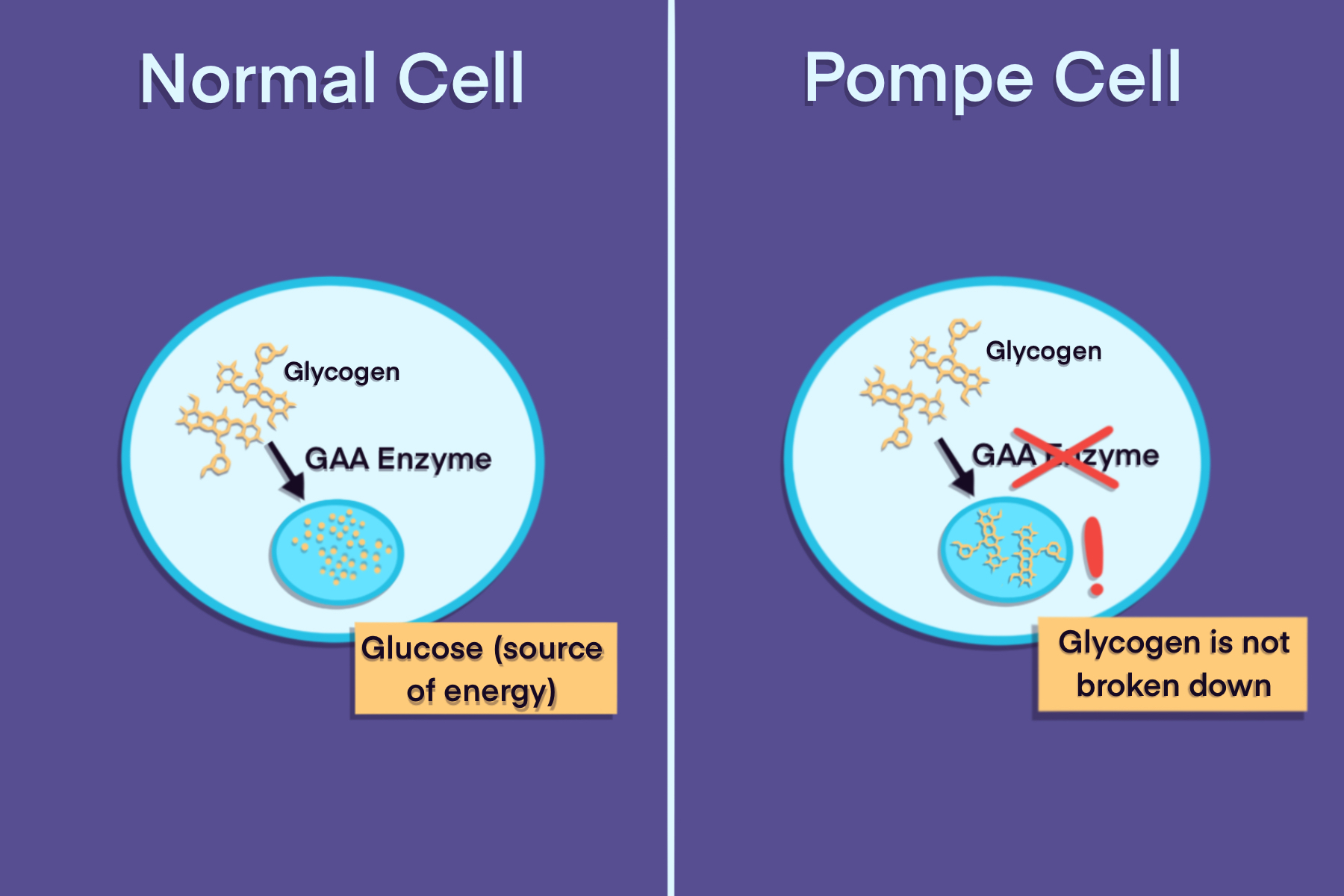 infographic depicting the differences between normal cells and Pompe cells