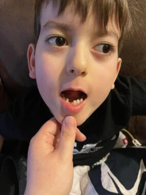 A 6-year-old boy angles his head and slightly opens his mouth to show where one of his bottom teeth fell out.